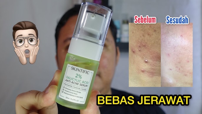 Salicylic Acid beneran ampuh buat jerawat batu? Ini review jujurnya